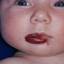 1. Hemangioma of Lips Pictures