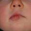2. Hemangioma of Lips Pictures