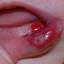 3. Hemangioma of Lips Pictures
