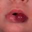 5. Hemangioma of Lips Pictures