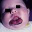 6. Hemangioma of Lips Pictures