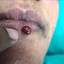 8. Hemangioma of Lips Pictures