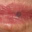9. Hemangioma of Lips Pictures