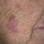 10. Facial Skin Cancer Pictures