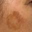 14. Facial Skin Cancer Pictures