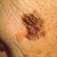 15. Facial Skin Cancer Pictures