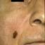 16. Facial Skin Cancer Pictures