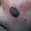 17. Facial Skin Cancer Pictures
