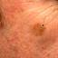 18. Facial Skin Cancer Pictures