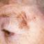 19. Facial Skin Cancer Pictures