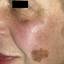 22. Facial Skin Cancer Pictures
