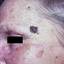 23. Facial Skin Cancer Pictures