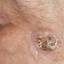 24. Facial Skin Cancer Pictures