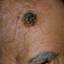 28. Facial Skin Cancer Pictures