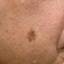 31. Facial Skin Cancer Pictures