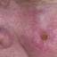 32. Facial Skin Cancer Pictures