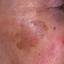 33. Facial Skin Cancer Pictures