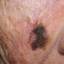 5. Facial Skin Cancer Pictures