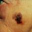 6. Facial Skin Cancer Pictures