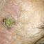 7. Facial Skin Cancer Pictures