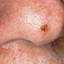 8. Facial Skin Cancer Pictures