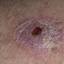 1. Signs of Skin Cancer Pictures