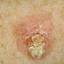 10. Signs of Skin Cancer Pictures