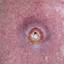 12. Signs of Skin Cancer Pictures