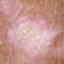 14. Signs of Skin Cancer Pictures