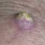 16. Signs of Skin Cancer Pictures