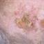 22. Signs of Skin Cancer Pictures