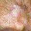 34. Signs of Skin Cancer Pictures