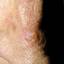 41. Signs of Skin Cancer Pictures