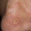 43. Signs of Skin Cancer Pictures