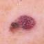 6. Signs of Skin Cancer Pictures