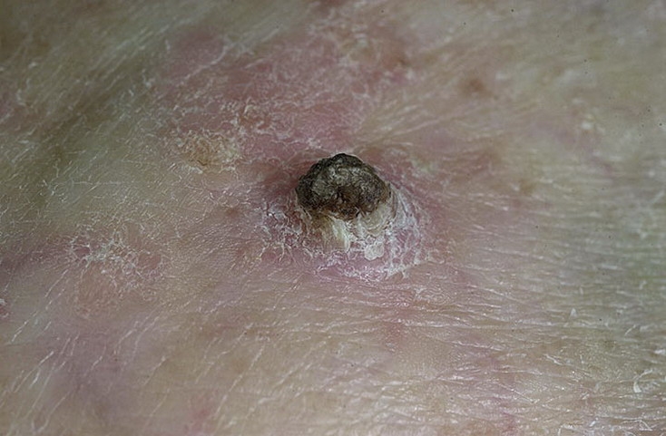 Signs of Skin Cancer Pictures – 48 Photos & Images / illnessee.com