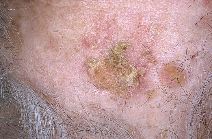 Signs of Skin Cancer Pictures – 48 Photos & Images / illnessee.com