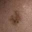 12. Signs of Melanoma Pictures