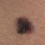 13. Signs of Melanoma Pictures