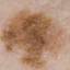 15. Signs of Melanoma Pictures