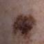 16. Signs of Melanoma Pictures