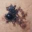 19. Signs of Melanoma Pictures