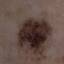 21. Signs of Melanoma Pictures