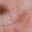 23. Signs of Melanoma Pictures
