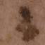 27. Signs of Melanoma Pictures