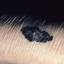 3. Signs of Melanoma Pictures