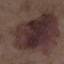 5. Signs of Melanoma Pictures