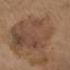6. Signs of Melanoma Pictures
