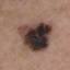 8. Signs of Melanoma Pictures