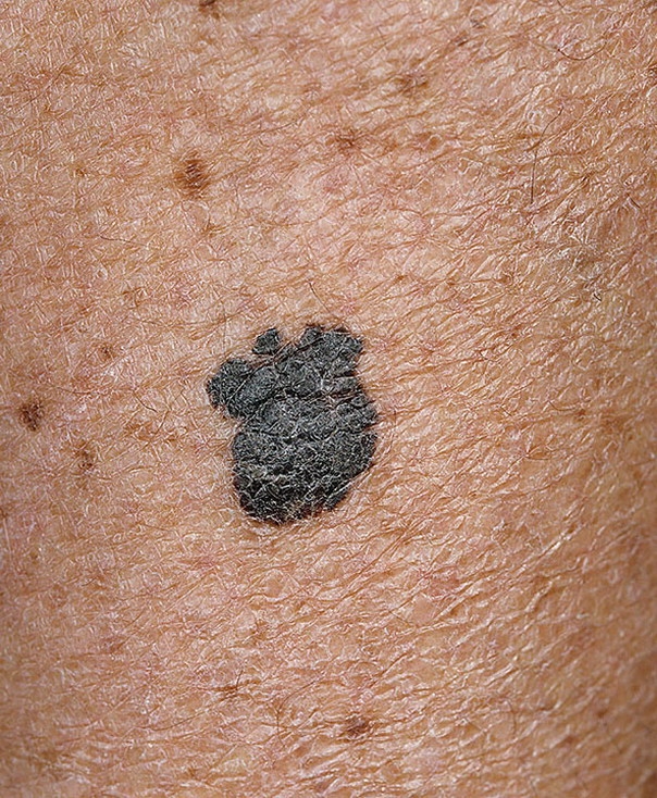 malignant-melanoma-pictures-54-photos-images-illnessee